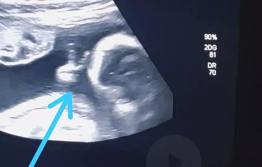  Durante ultrassom, bebê faz ‘V de vitória’ e pai com câncer acredita em sinal divino