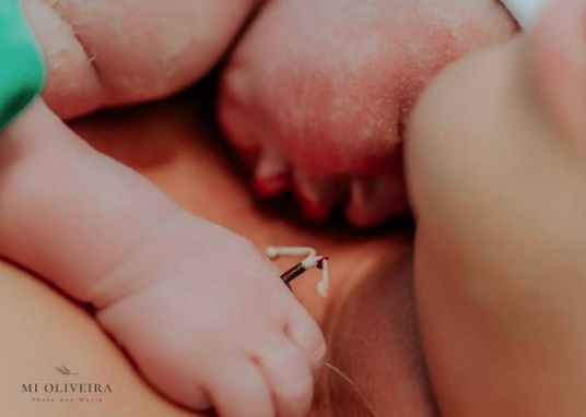 No Rio de Janeiro, bebê nasce segurando DIU usado pela mãe