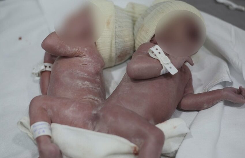  Gêmeos nascem unidos por osso da coluna no Paraná; entenda